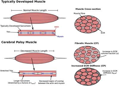The Contributions of Extracellular Matrix and Sarcomere Properties to Passive Muscle Stiffness in Cerebral Palsy